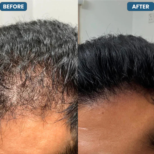 Hair Growth Roll-On Serum