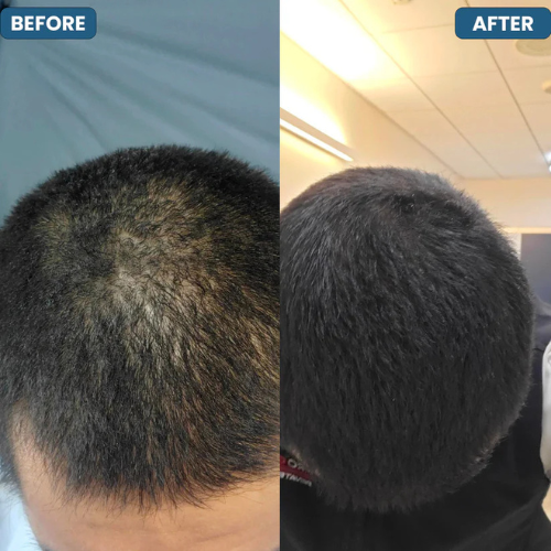 Hair Growth Roll-On Serum